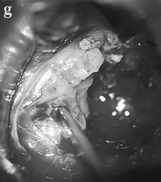 对CPA区肿瘤部分进行内部切除。