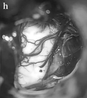 肿瘤已完全切除，解除脑干压迫。