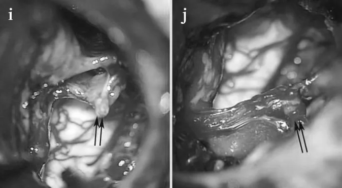面神经被肿瘤浸润， 在图像上可以看到近端、残端有一些附着的肿瘤(箭头)。
