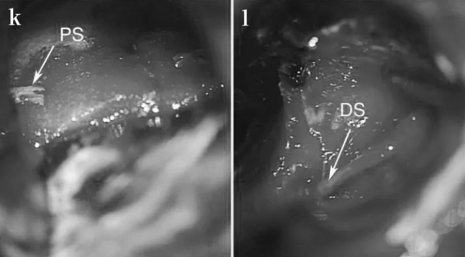 重建近端(k)和远端(l)神经残端(PS近端残端，DS远端残端)