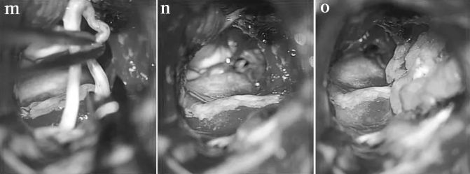准备合适长度的移植体(m)， 并用纤维蛋白胶(n)固定到残端，脂肪用于防止脑脊液泄漏(o)。