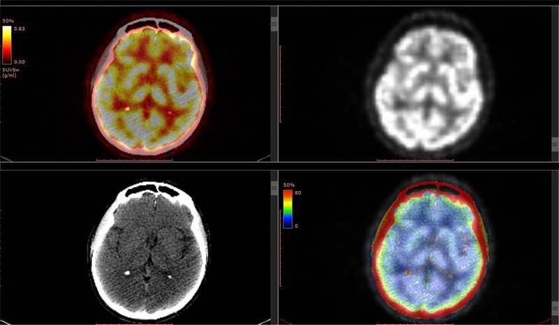 颅脑斜坡占位MR表现是什么？占位边界清晰是好是坏？
