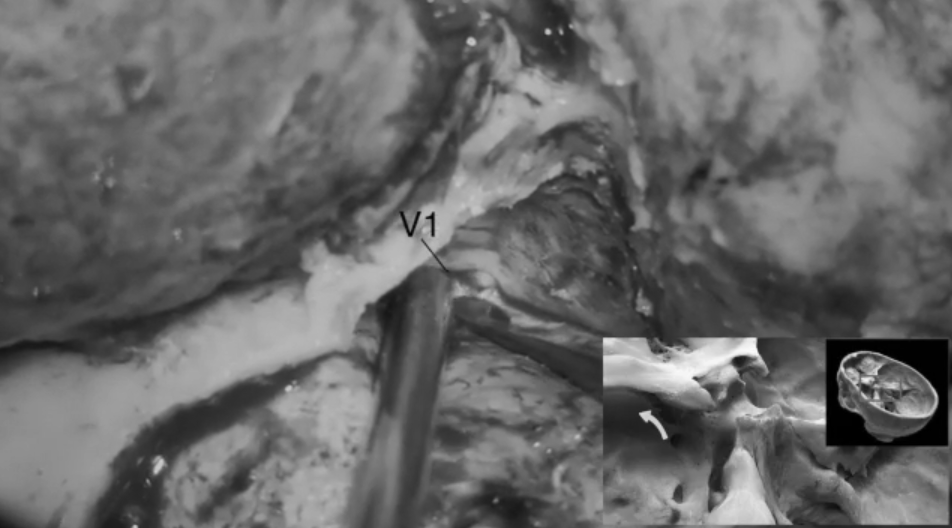 定位三叉神经V1段，以助显露眶上裂;游离并进一步解剖眶上裂，识别、电凝并切断眶脑膜韧带。