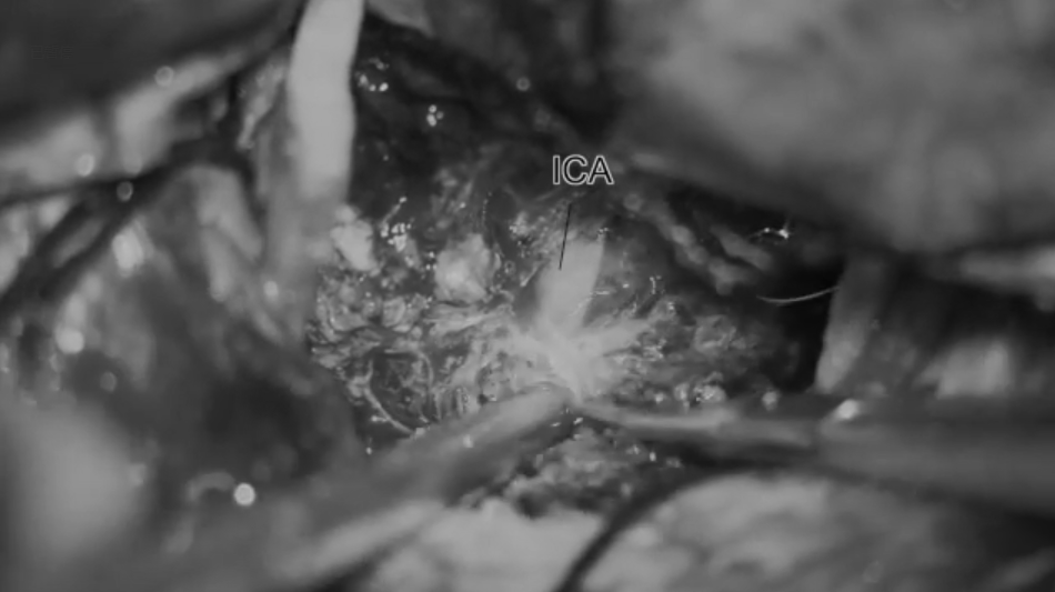 深入肿瘤后可见被包绕的颈内动脉;再向外下可见Liliequist膜及动眼神经。