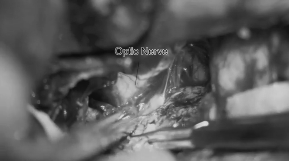 肿瘤全切后，可见良好的视神经-颈内动脉三角及动眼神经三角，可见基底动脉、乳头体及垂体。