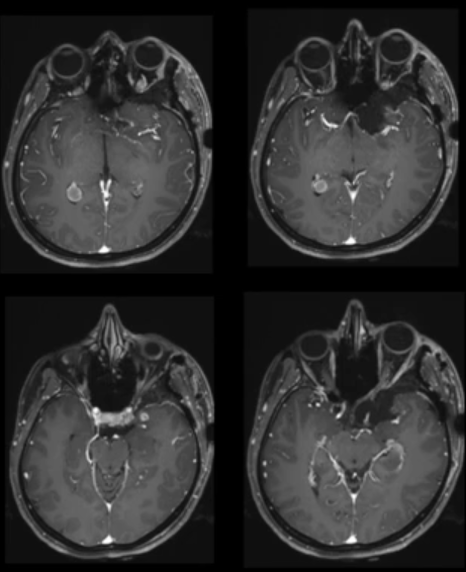 术后MRI显示肿瘤全切除
