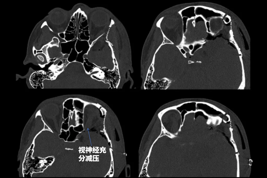 术后CT：这些骨窗图显示了骨质磨除范围和术后重建的程度