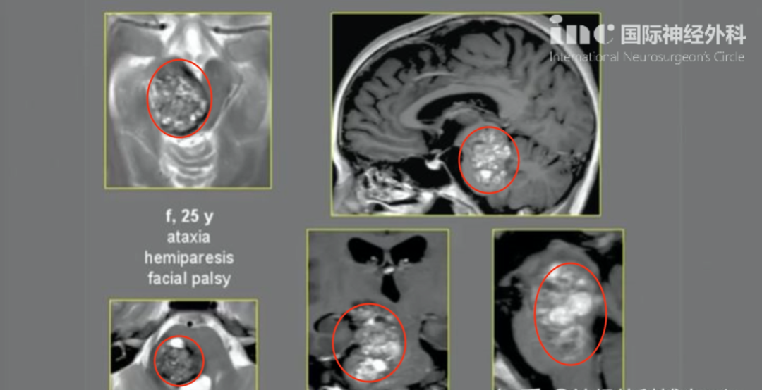 (中脑-脑桥）脑干巨大海绵状血管瘤。术前影像：中脑、脑桥巨大占位