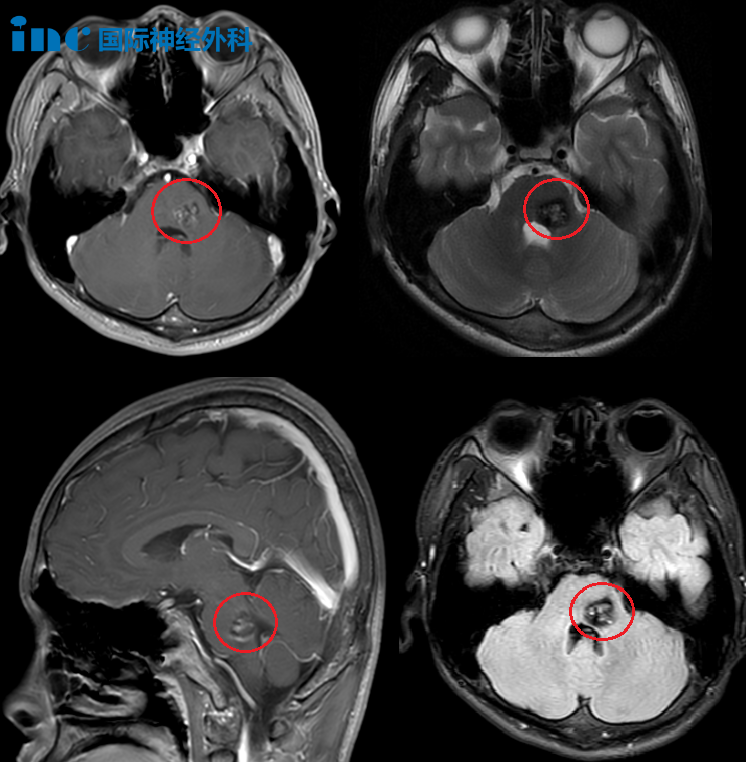 病灶位于桥脑左侧，并且与桥臂的交界处，病灶大，位置深。