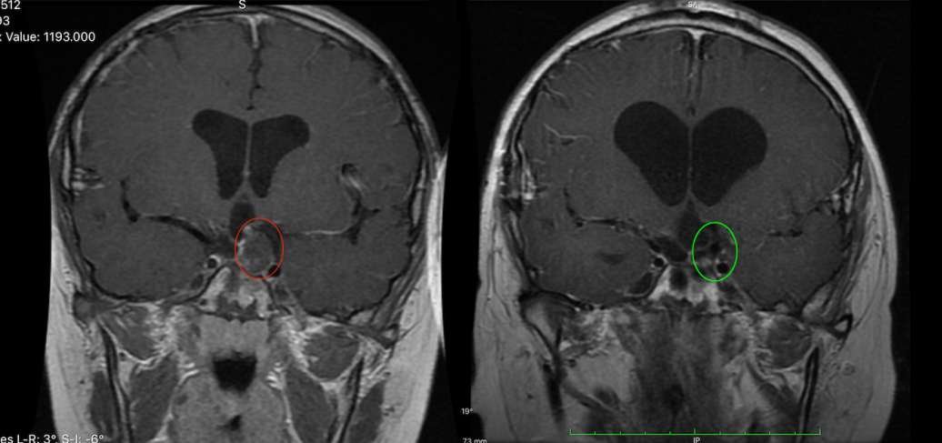 图为小俊手术前后对比，肿瘤顺利切除