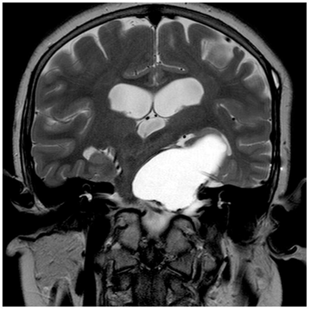 囊性颅咽管瘤用Ommaya储液囊保守治疗，上图为置入Ommaya储液囊之前