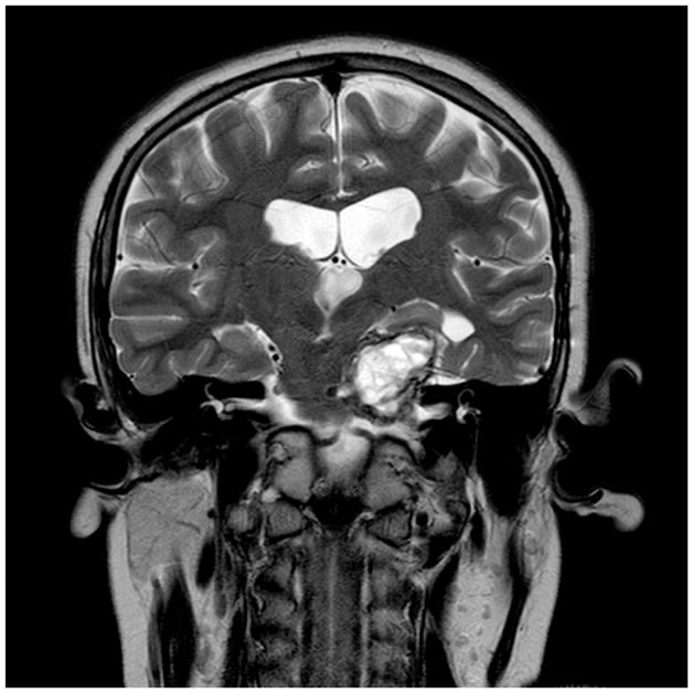 囊性颅咽管瘤用Ommaya储液囊保守治疗，上图为置入Ommaya储液囊之后以及反复拍打之后，囊肿大小明显减少