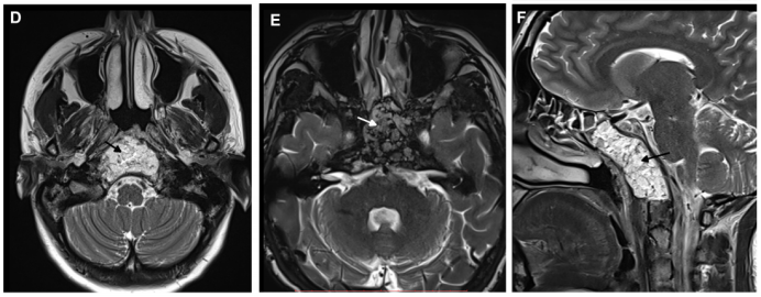 最终手术顺利完成，术后 MRI 证实肿瘤被完全切除（箭头所指为填充的脂肪），同时鼻窝保持完整。在2个月的随访中，内镜检查没有发现结痂，患者也没有抱怨任何鼻腔不适。