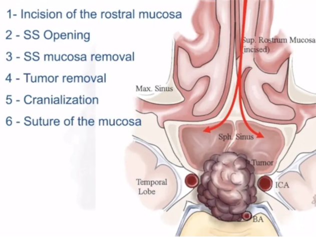 切除肿瘤之后，再去重建蝶窦部分的颅底，塞进去一些脂肪组织。