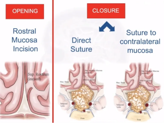 可能看到粘膜切除的位置，我们直接缝合，那么一直去保持端对端的去缝合鼻黏膜。