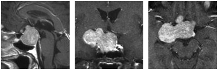磁共振成像(MRI)检查揭示了一个位于右侧、紧靠垂体区域的大型垂体腺瘤，并且该肿瘤在注射对比剂后呈现吸收现象。
