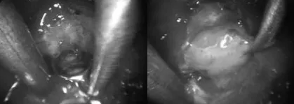 内镜下的成像清晰地显示了在真空吸引和刮匙工具的配合下，肿瘤被逐步切除的过程。在该过程中，可以观察到典型的白色、易于溶解的垂体组织。