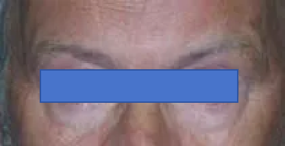 术后MRI显示，肿瘤已完全切除，没有留下任何残余。施罗德教授成功地维护了垂体柄的完整性，并且保全了垂体柄附近狭窄区域内正常的垂体组织。