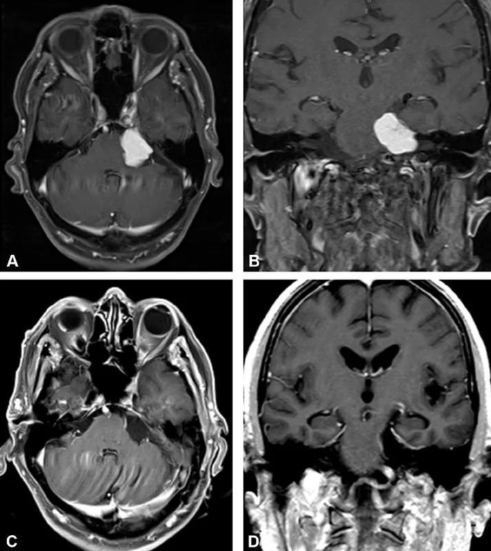 (A)术前桥小脑角脑膜瘤的轴位及(B)冠状位磁共振影像,可见肿瘤已对脑干造成显著压迫。(C,D)术后磁共振影像(C为轴位,D为冠状位)显示肿瘤已获大体全切除。