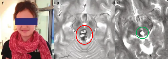 手术全切脑海绵状血管瘤，喜喜术后无任何并发症，顺利出院后她笑容如初！