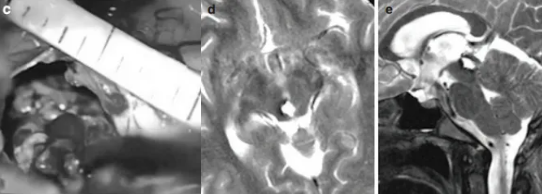手术最终成功全切脑海绵状血管瘤，术后喜喜的恢复情况令人欣慰，没有出现任何术后并发症，在乐观的家庭氛围感染下，当初那个爱笑的女孩又回来了！