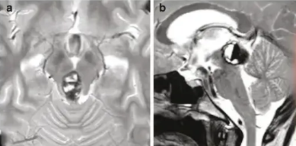 肉眼可见的占位位于大脑深处的松果体区，并已经出现了梗塞性脑积水。