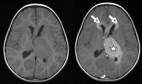 图 1 术前轴位对比增强 T1 加权成像。病变呈脑内生长，并延伸至左侧脑室枕角(星号)。双侧额叶在脑室额角周围受浸润(箭头)。