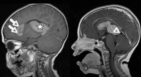 图 2 术前矢状位对比增强 T1 加权磁共振成像。病变的分布清晰可见。右侧可见病变与大脑内静脉的紧密联系(箭头所指)。箭头标记了沿脑室额角分布的病变。星号表示轴内主要病变。