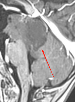 “继续观察只会放任肿瘤继续进展——若体积超出临界值将不再具备手术条件！因此延长观察期属重大决策失误。”