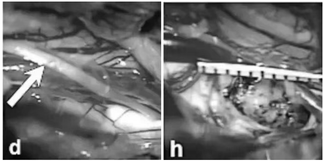 术中记录(图d-h)