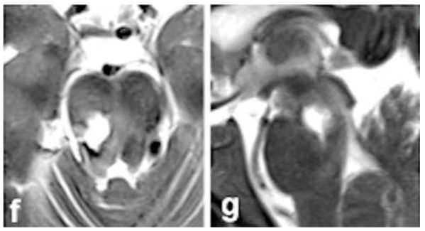术后影像(图f-g)