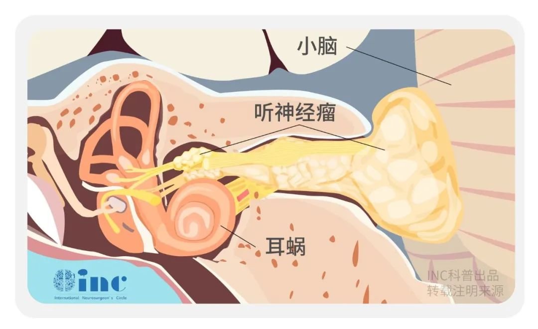 听神经瘤