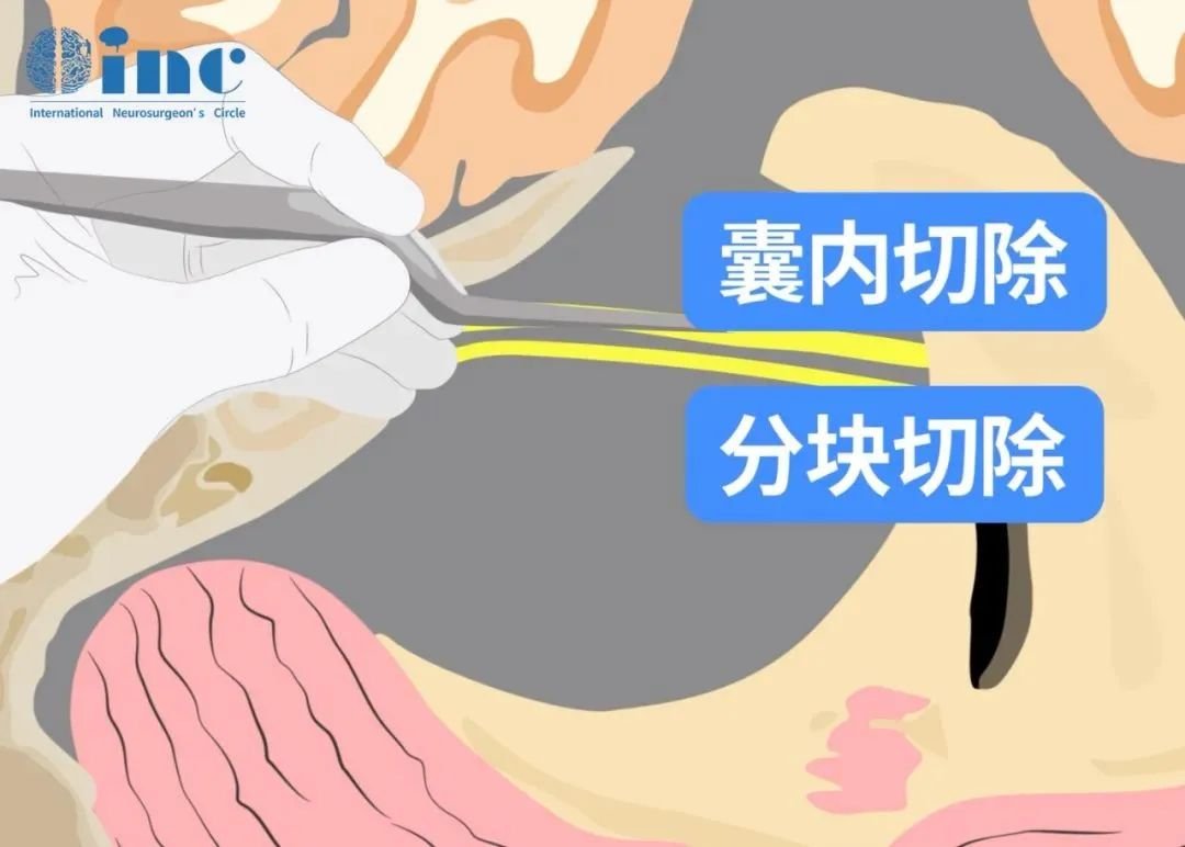 内听道磨除术及修补术