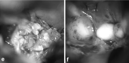 内镜下可见肿瘤内的头发和牙齿