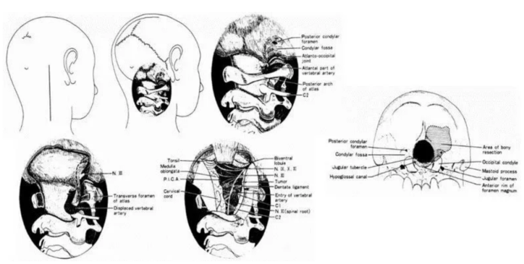 图：INC巴特朗菲教授导师Seeger教授手绘枕骨大孔区