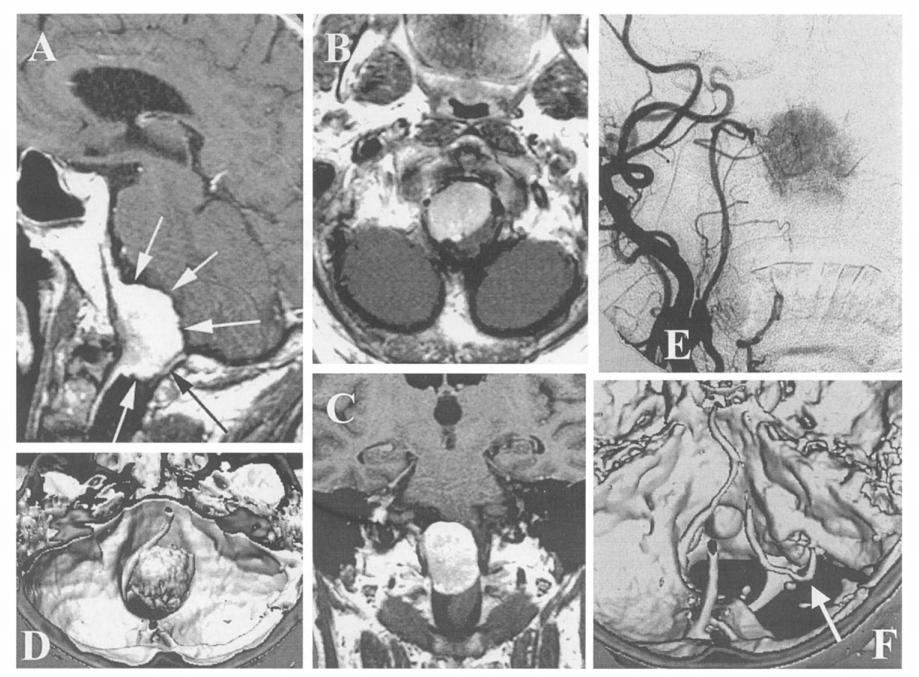 59岁男性枕骨大孔区巨大脑膜瘤案例