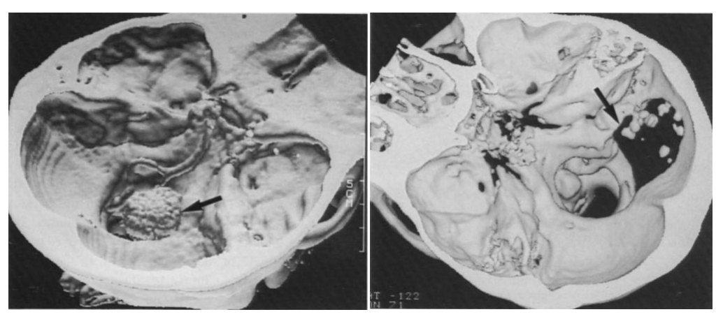 骨瓣切除范围向外侧延伸至乙状窦内侧缘(箭头所示);乳突及 C1 椎板保持完整。