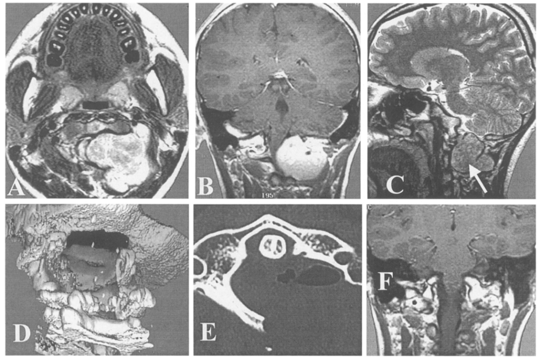 13 岁男孩 C1–2 节段左侧巨大硬膜内-外神经鞘瘤案例