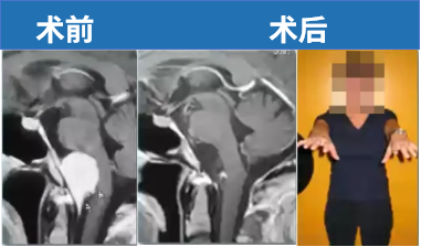 46岁女性，出现步态障碍、感觉障碍，术后状态良好，无神经功能损伤。