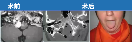 51岁女性，出现眩晕，轻微舌下神经功能障碍。顺利全切后，舌下神经功能障碍消失。