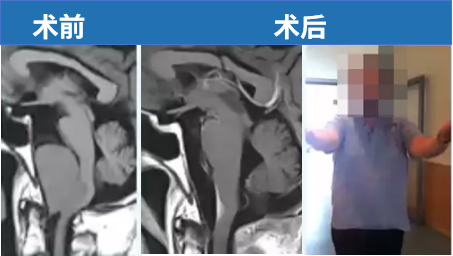 54岁男性，出现颈痛、共济失调、吞咽困难、舌下神经麻痹。顺利全切后，症状消失，状态良好。无神经功能损伤。