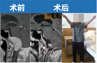 53岁男性，手臂和脸部感觉迟钝。顺利全切后，运动功能恢复，无损伤。