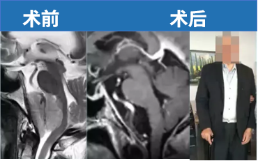 65岁男性，出现步态共济失调、吞咽困难。手术顺利全切，状态良好，无神经功能损伤。