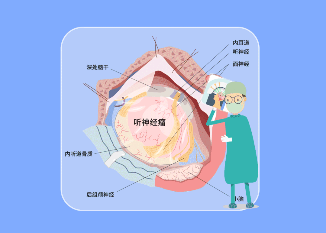 听神经瘤早发现早治疗