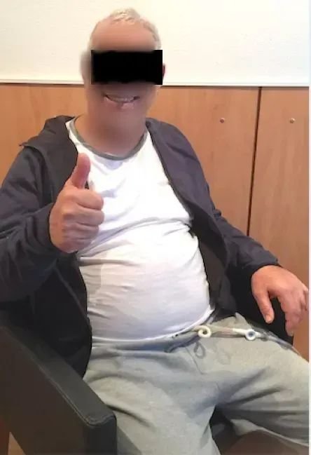 脑干海绵状血管瘤患者