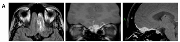 图1A：2013年9月，影像学首次确诊时
