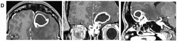图1D：第二次活检后5个月，病灶再次增大