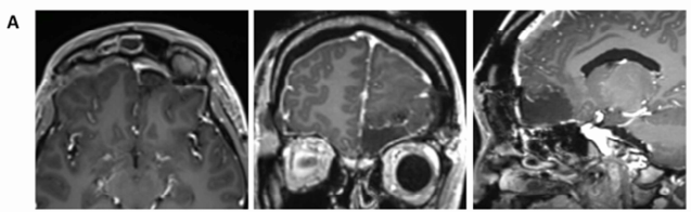 图2A：术后MRI示额部肉芽肿已完整切除