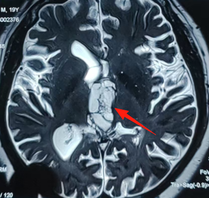 一个40×25×31mm的巨大肿瘤已完全占据第三脑室，从室间孔向下压迫中脑。