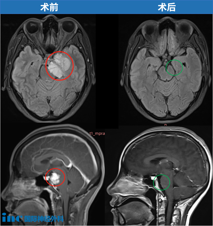 36岁的小宛、岩尖区4.5cm脑膜瘤，视力下降